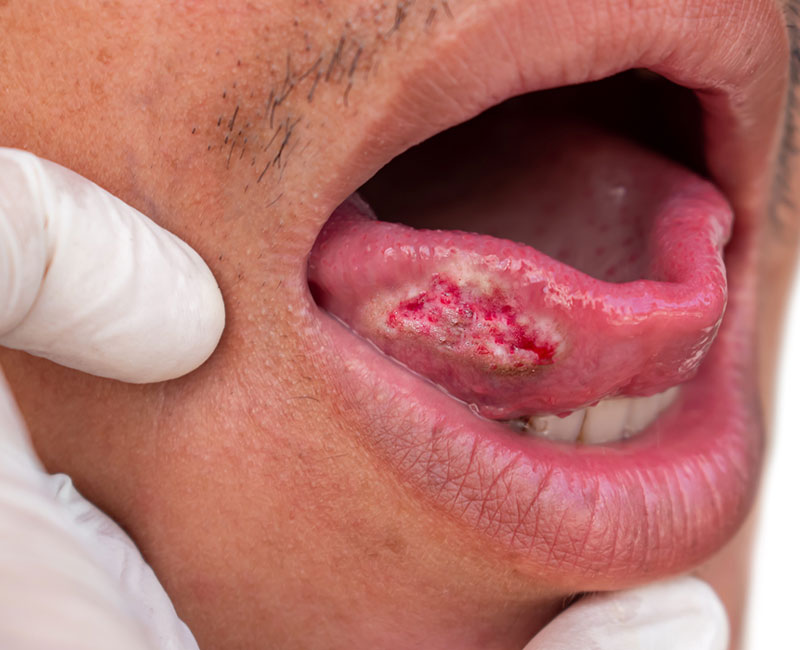 Suspicious non-healing ulcer with irregular borders