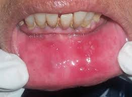 Canker sore example on oral mucosa