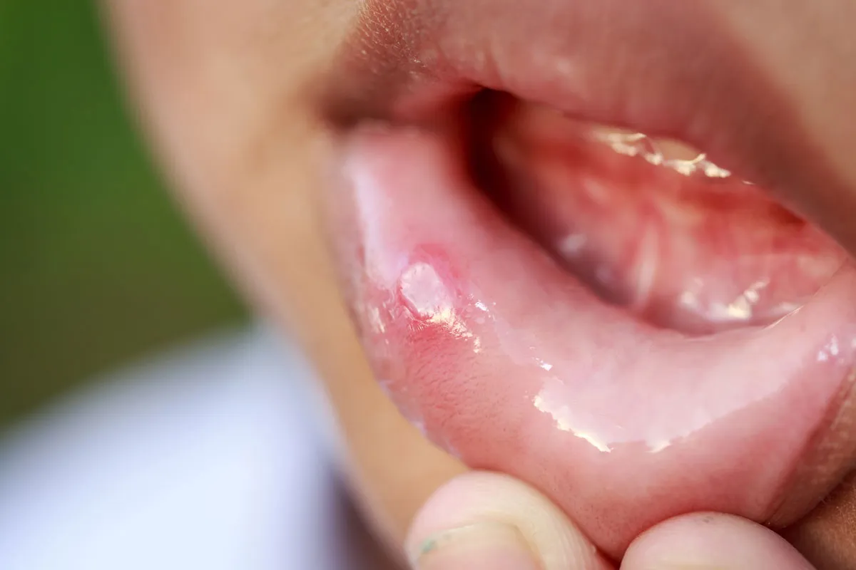 Oral thrush (candidiasis) white plaques
