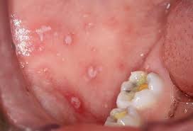 Herpetic ulcer pattern example