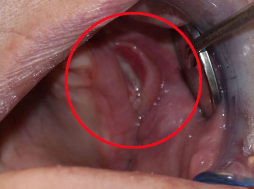 Traumatic mouth ulcer caused by irritation